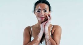 Vamos falar sobre vitiligo?